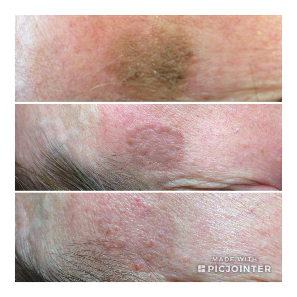 Pigmentation before and after cryotherapy — Catherine Webb